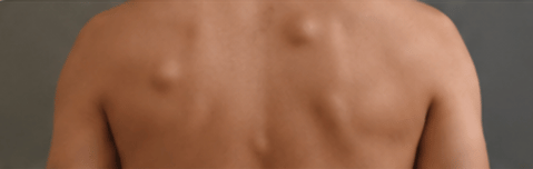Multiple lipoma